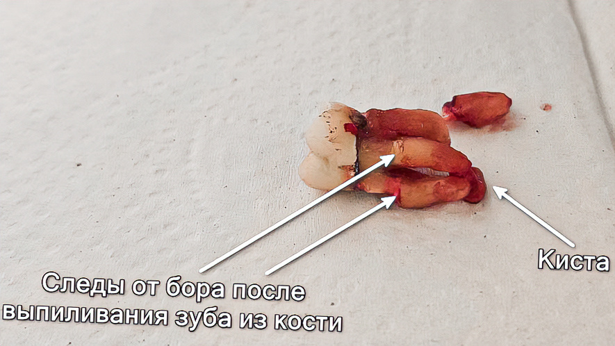 Зуб 1.6 с кистой и следами выпиливания из кости