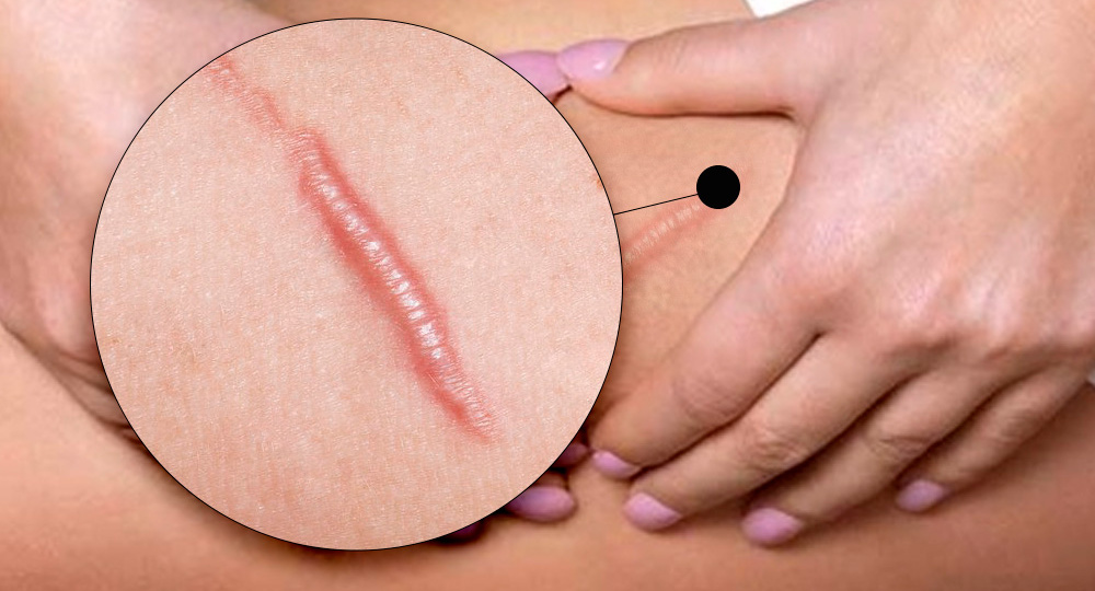 Татуировки на шраме: от А до Я. Когда можно делать тату на шраме?