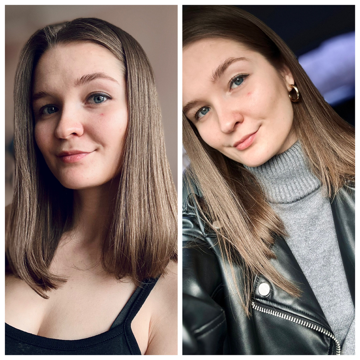 Сосудистая звездочка (телеангиэктазия)