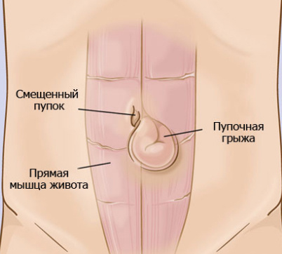 Пупочная грыжа. Источник – https://www.scz.ru/hospital/obshchaya-khirurgiya/pupochnaya-gryzha-simptomy-diagnostika-operatsiya/