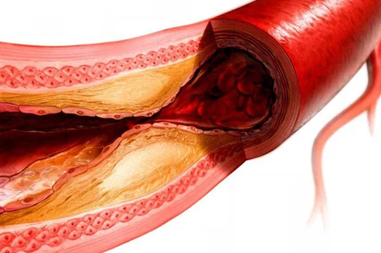 Холестериновые бляшки в сосудах