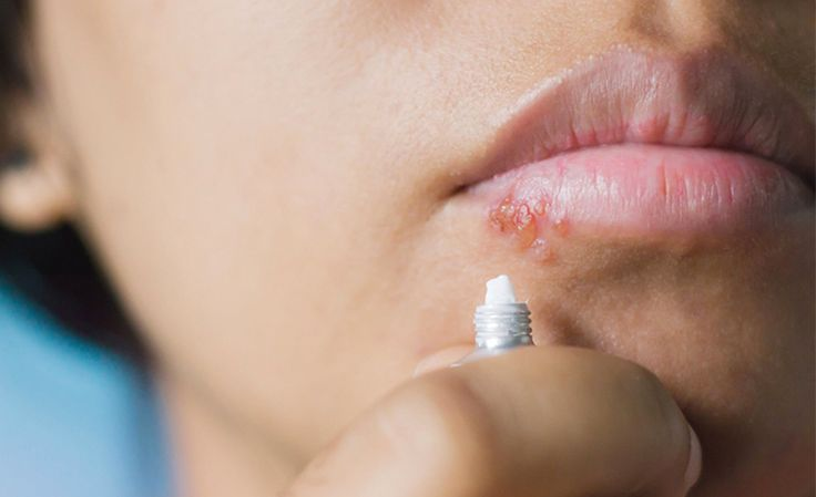 Как быстрее справиться с «простудой на губах» и что делать опасно: рассказала иммунолог