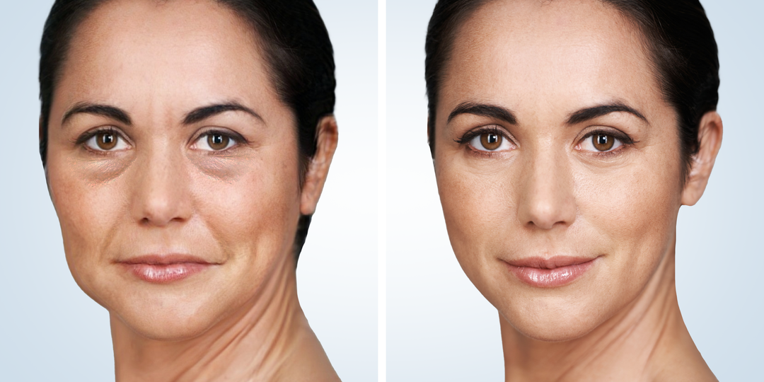 Изменила подход к себе и жидкость ушла — как убрать отеки с лица и тела полностью