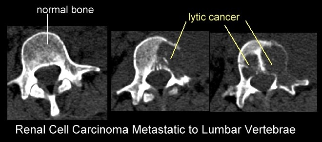 Справа - литический метастаз в позвонке