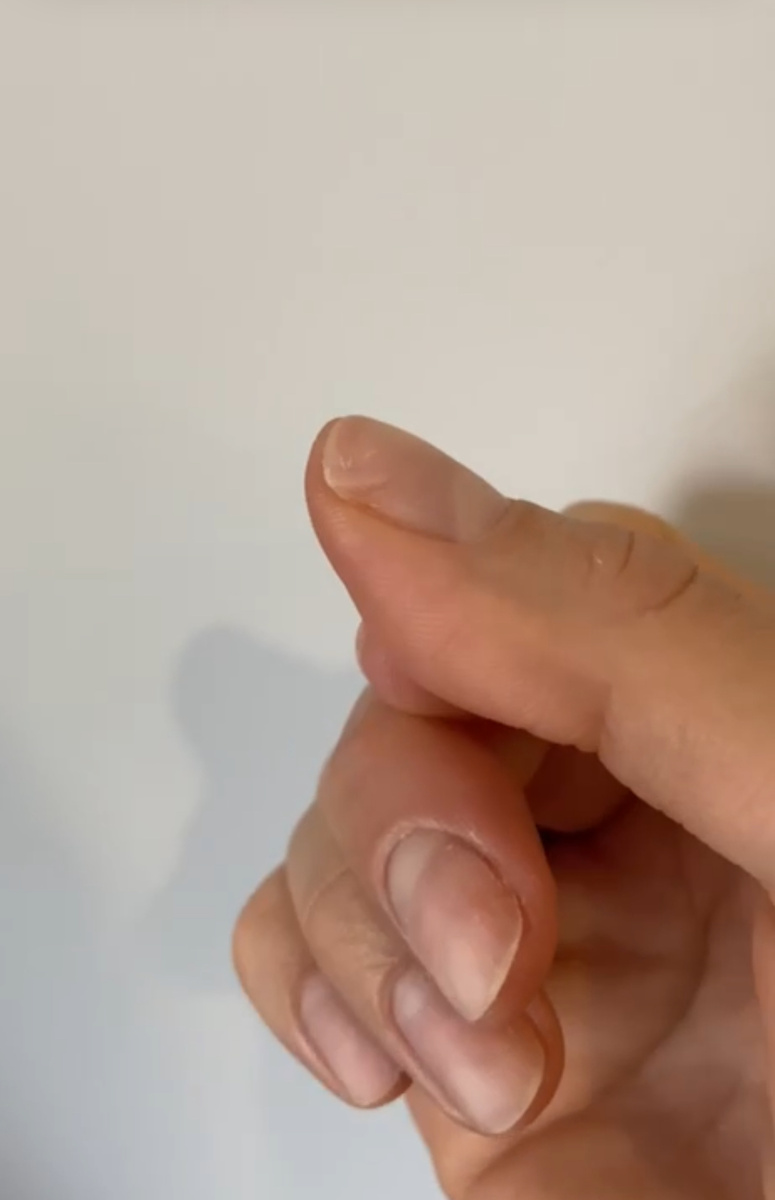 Это уже фото ногтей в процессе отращивания ногтевой пластины. Здесь видно - какие пропилы от фрезы были изначально. 