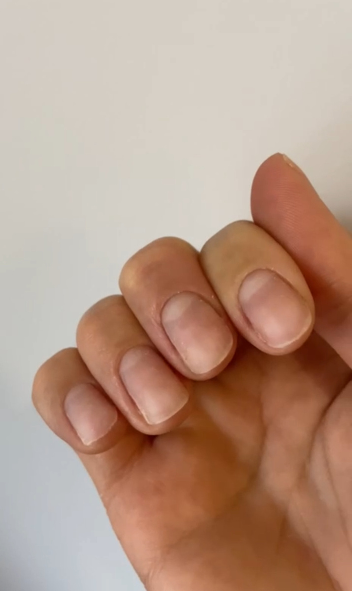 Точки вроста перепилены - поэтому ноготь растет какой-то неправильной формы, полутрапецией. 