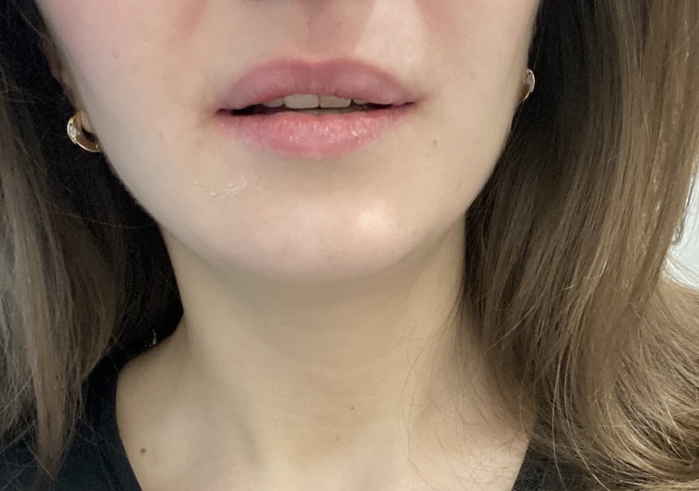 Сразу после операции - начинает формироваться отек верхней губы и тканей над ней