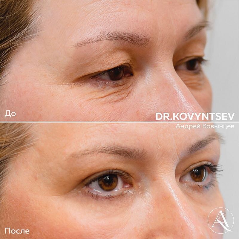 Верхняя и нижняя блефаропластика (после через 1,5 месяца)