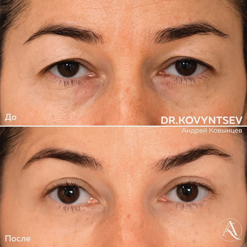 Верхняя и нижняя блефаропластика (после через 9 месяцев)