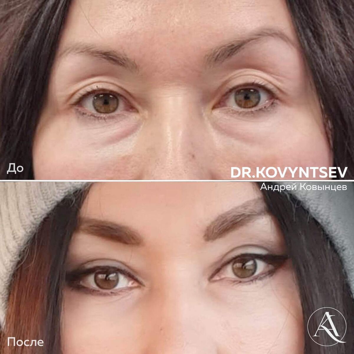 Верхняя и нижняя блефаропластика (после через 1,5 месяца)