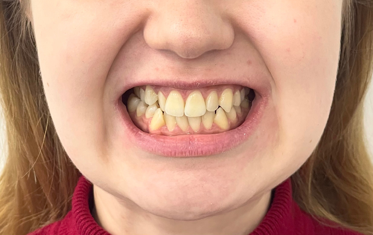 Прикус до ортодонтического вмешательства