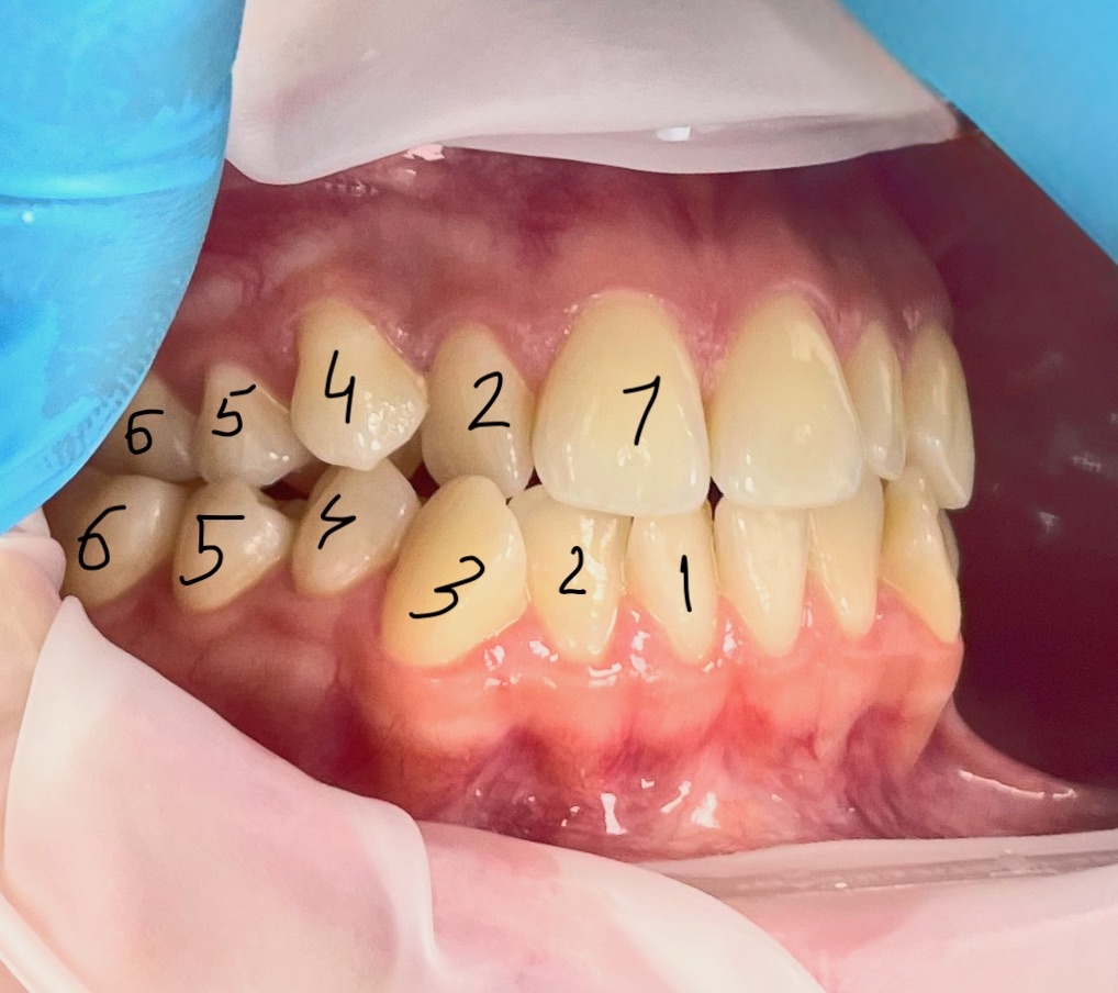 Клыка-то нет