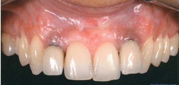 Фото не моё, просто для примера - у меня было что-то подобное в области центрального резца, но намного хуже и больше