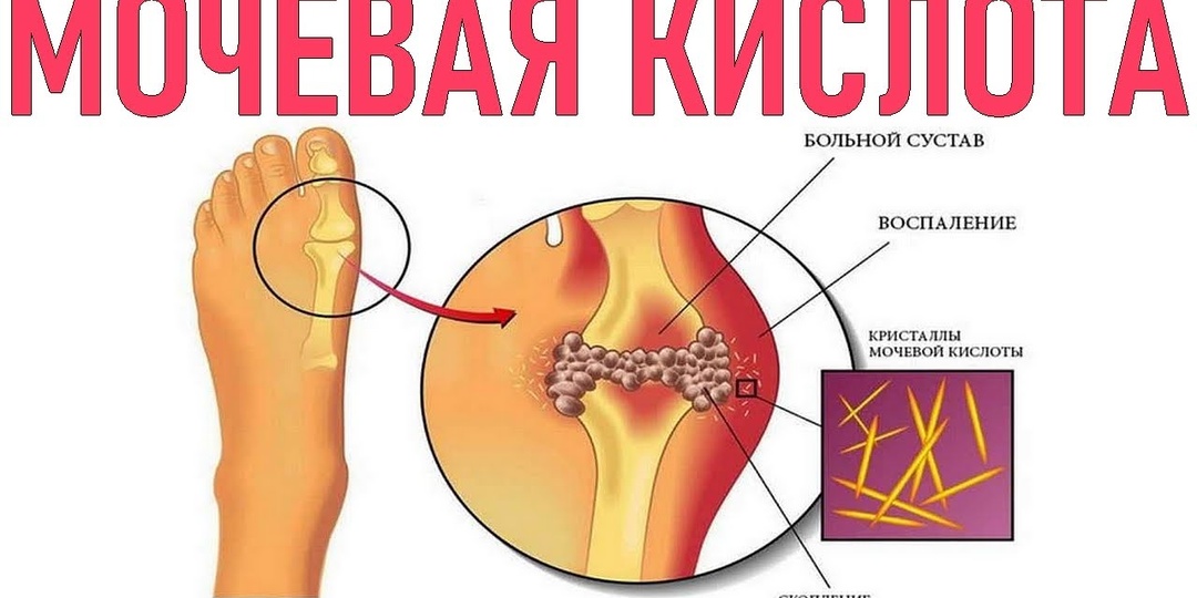 Мочевая кислота: что это и как её уровень влияет на суставы
