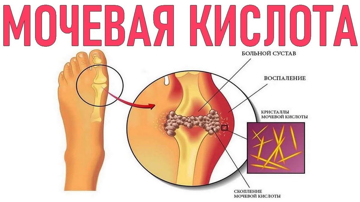 Мочевая кислота: что это такое и как её уровень влияет на здоровье ваших суставов