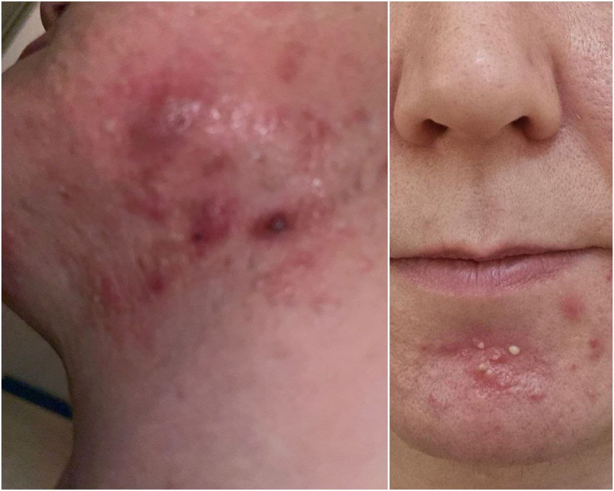 Пациент с тяжелой формой акне
