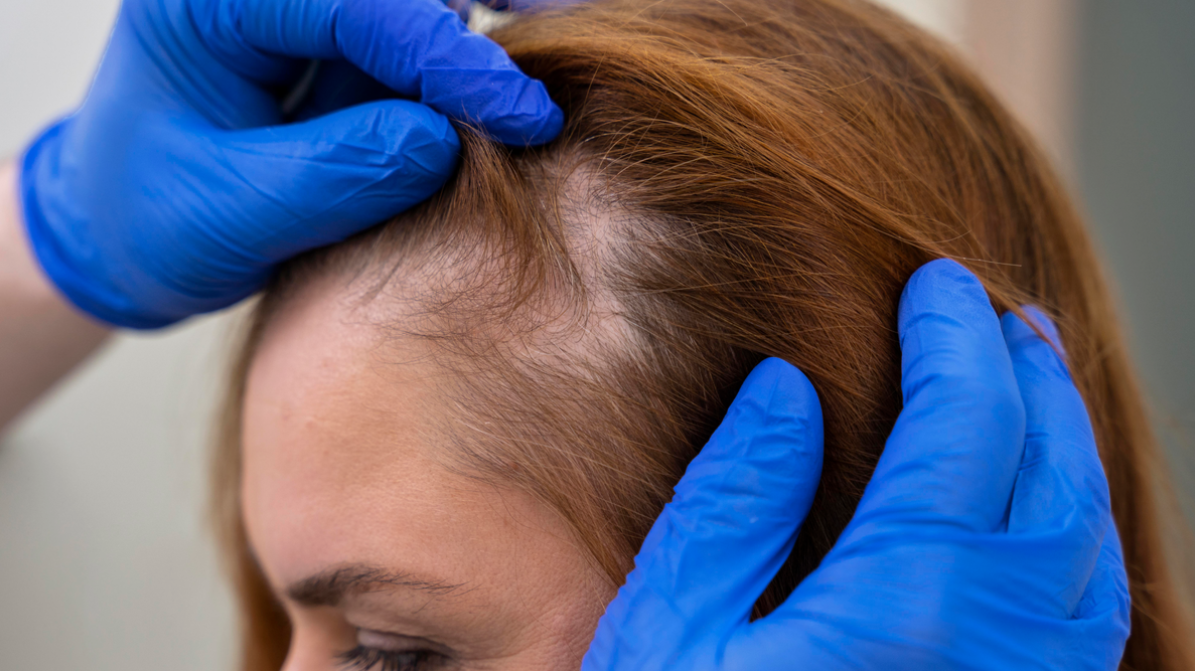 Аутоиммунная алопеция: причины возникновения и методы лечения