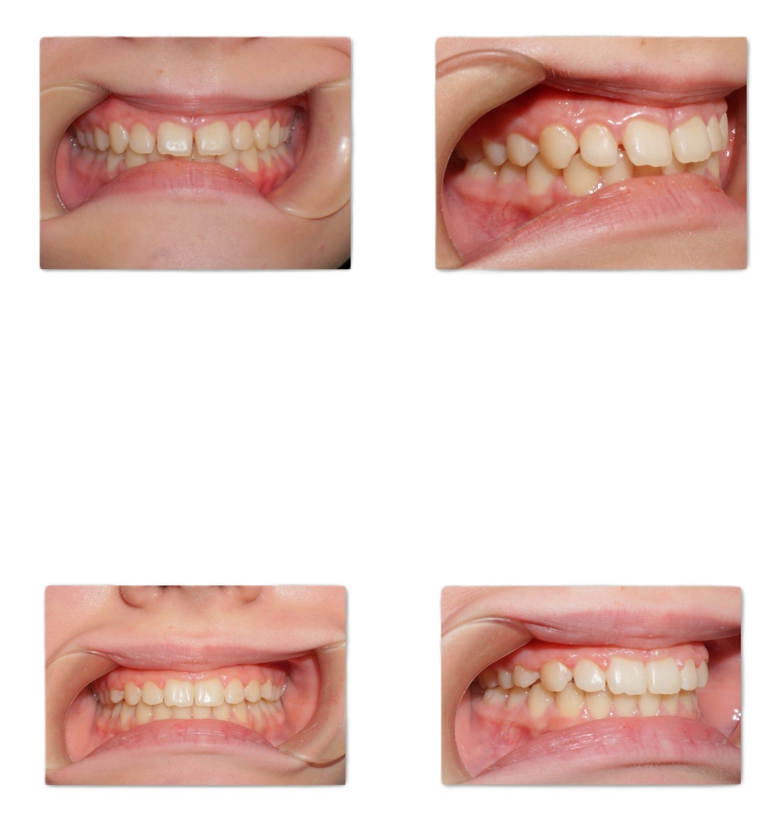До и после ортодонтического лечения. Ретенционный период- несъемные ретейнеры на верхней и нижней челюсти. Фото автора.
