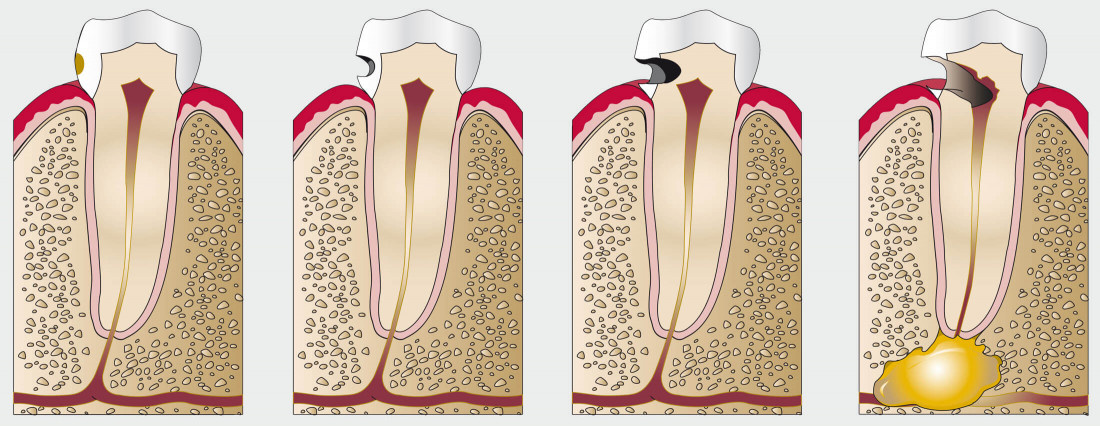 Стадии развития скрытого кариеса на контакте между зубами. Источник: интернет.