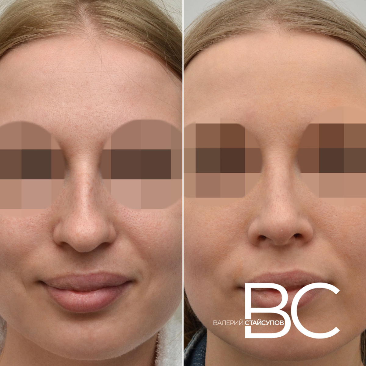 Закрытая ринопластика, пластический хирург Стайсупов В.Ю.