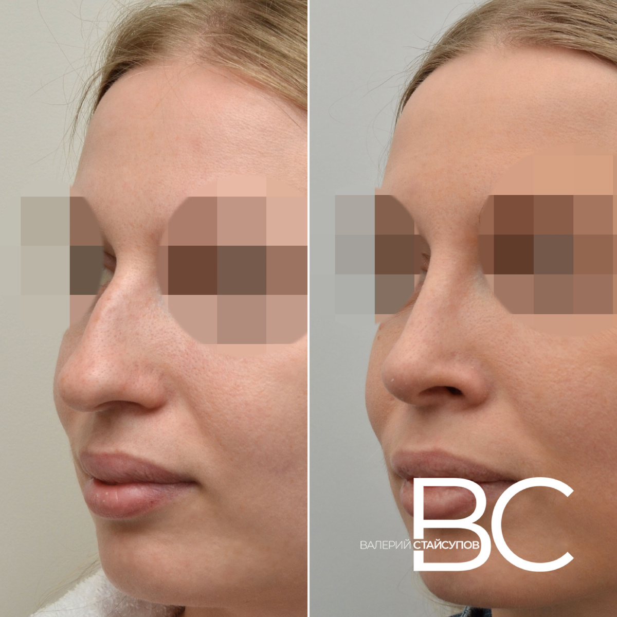 Пластическая операция - ринопластика, хирург Стайсупов В.Ю.