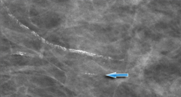 Примерно у 50% женщин старше 70 лет есть доброкачественные сосудистые микрокальцинаты