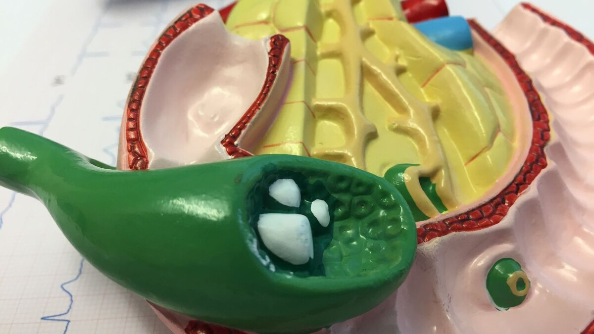 Кисель вместо желчи и камни как снежная баба: что на самом деле происходит в вашем желчном пузыре 