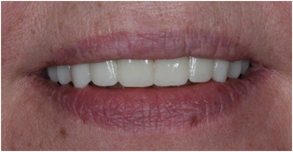 *пациентка стоматологии АИСТ после тотального восстановления нашими специалистами