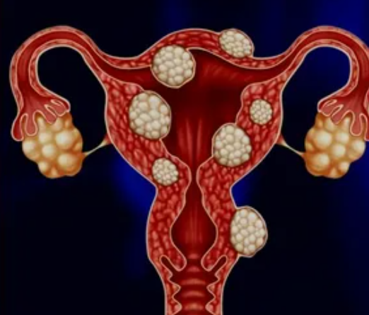 Миома матки