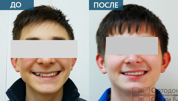 Исправление прикуса у подростка до и после