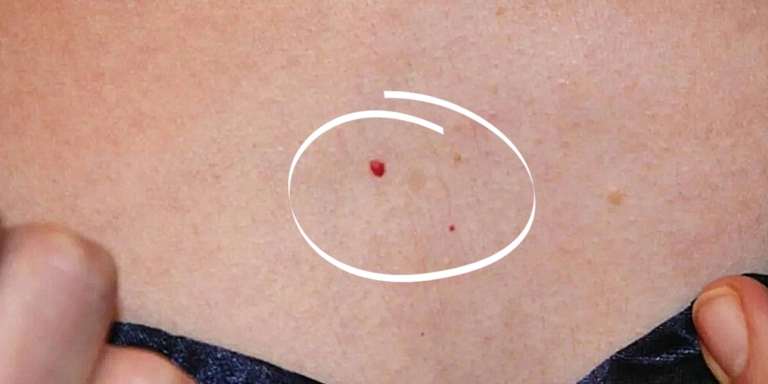 Красные родинки гемангиомы — тревожные сигналы. Как по ним определить, что с организмом не в порядке