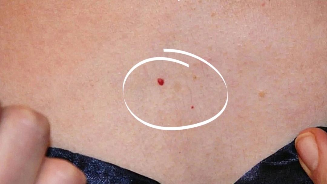 У меня такая появилась после родов на груди