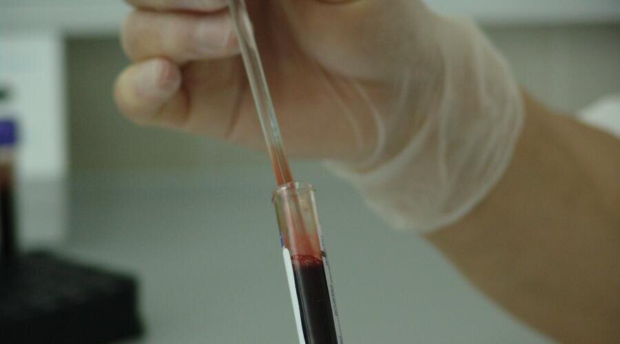    Различие ферритина и гемоглобина при выпадении волос Фото: по лицензии СС0 PxHere.com