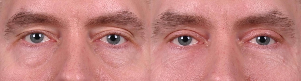 Объемное омоложение век фото до и после. Фото с сайта хирурга Д.Р. Гришкяна. Имеются противопоказания, требуется консультация специалиста