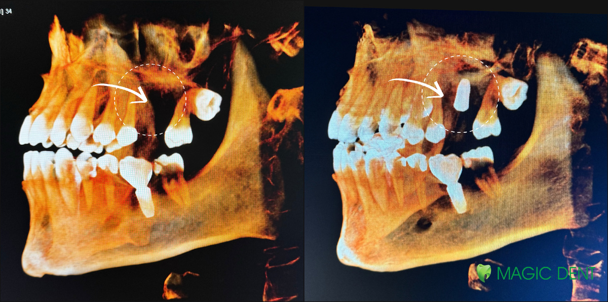 КТ до и после импдлантации зуба 26 на верхней челюсти