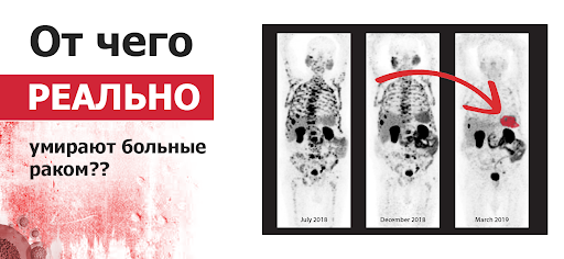 Отчего умирают пациенты с онкологией чаще всего? Разбираем экстренные случаи.