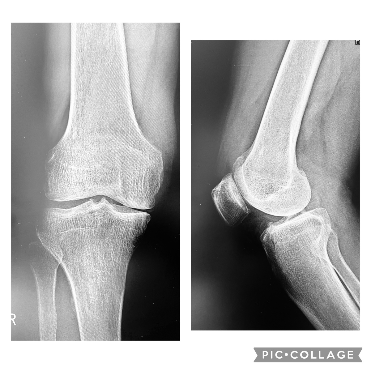 Вполне приличная рентгенограмма. Потому что не артроз.