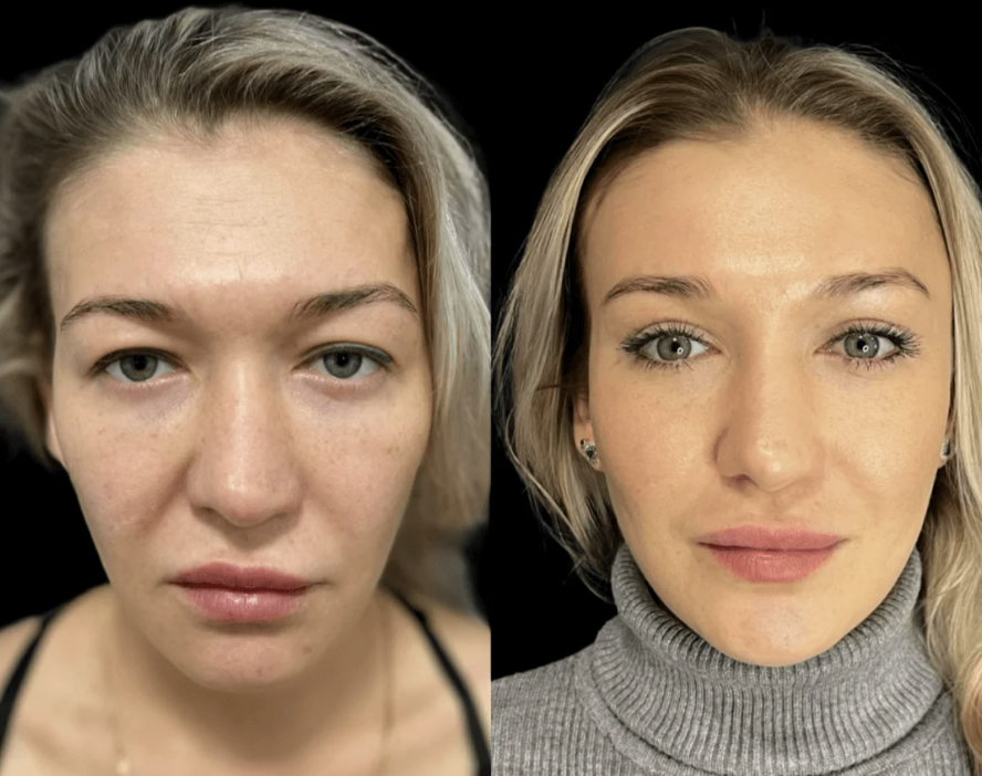 Верхняя блефаропластика / Пластический хирург Владимир Зленко