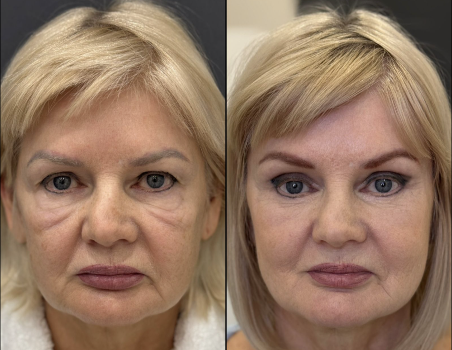 Блефаропластика верхних и нижних век. Эндоскопическая подтяжка верхней и средней трети / Пластический хирург Владимир Зленко