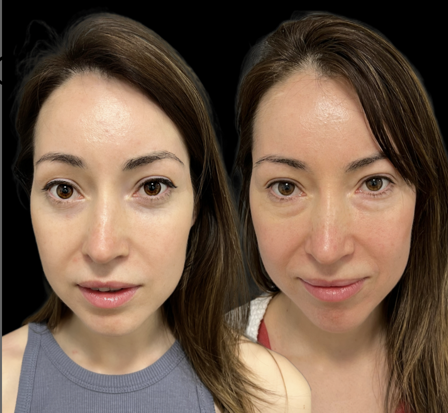 Трансконъюнктивальная блефаропластика / Пластический хирург Владимир Зленко