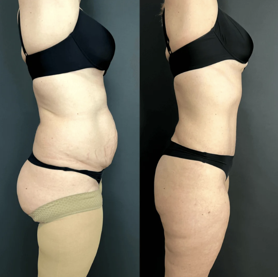 Абдоминопластика с липосакцией живота и спины / Пластический хирург Владимир Зленко