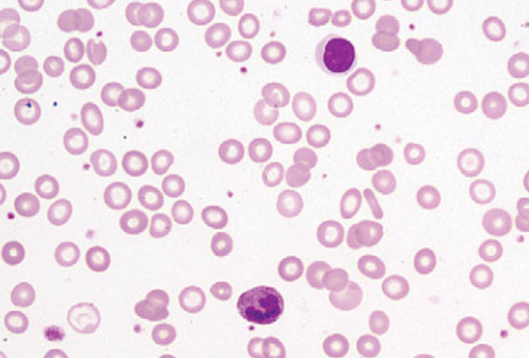 железодефицитная анемия ЖДА