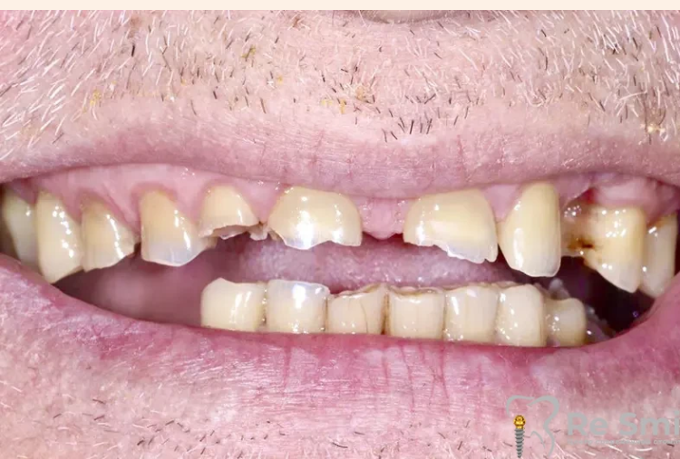 Пациент обратился в клинику с проблемой стираемости зубов и частичном их отсутствии.