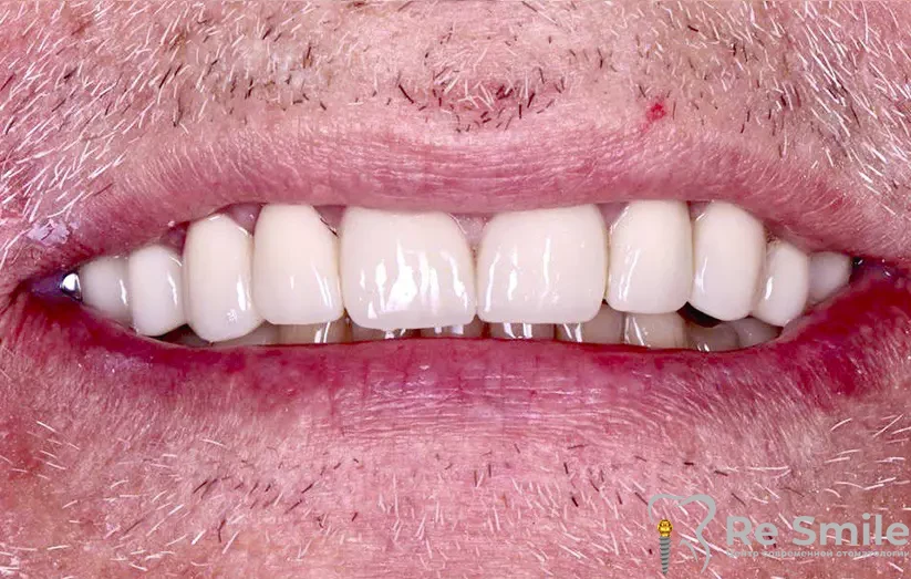 Была полностью восстановлена эстетика зубного ряда циркониевыми коронками на своих зубах и одновременно были установлены импланты в области отсутствующих зубов. Также, установлены циркониевые коронки на винтовой фиксации.
