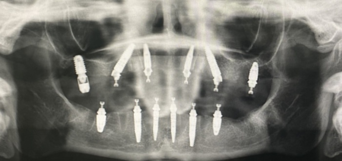 Итог хирургического этапа. Снимок мой. 