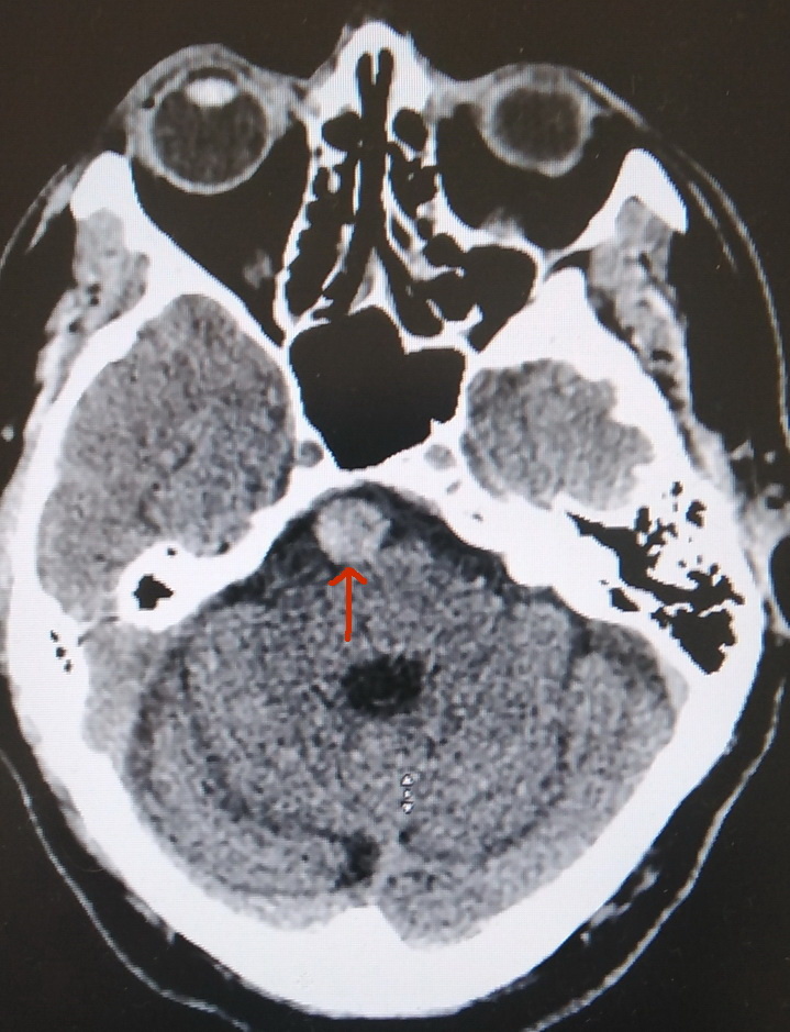 Этот "шарик" и есть аневризма. 