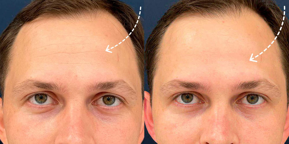 Разглаживание морщин у мужчин на лбу. 1 процедура