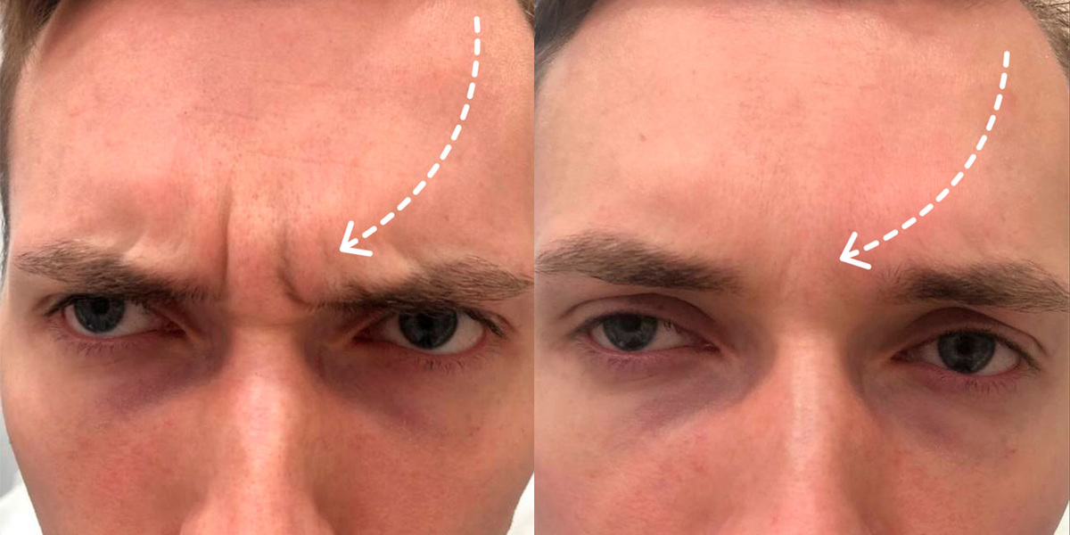 Морщины на лбу у мужчин. Коррекция препаратом Диспорт. ! процедура
