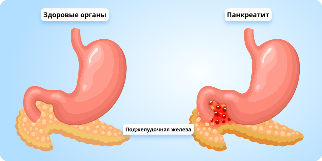 Первые симптомы Панкреатита – острый и хронический