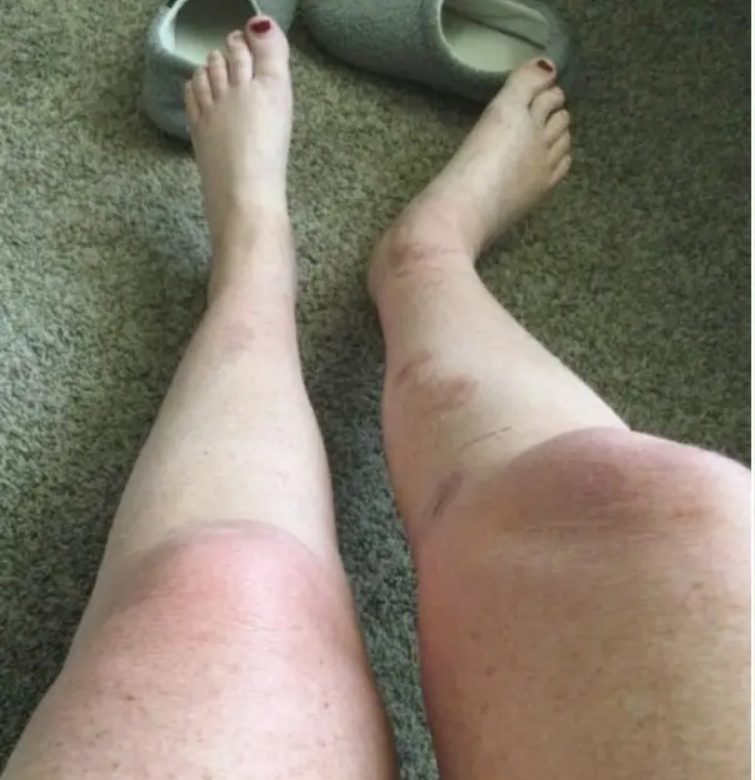 Так выглядят ноги пострадавшей фанатки Меган..